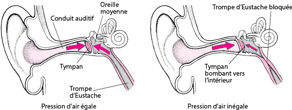 Schéma détaillé du barotraumatisme de l'oreille dans le contexte de la plongée sous-marine