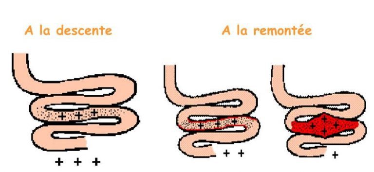 Schéma expliquant le barotraumatisme de l'estomac et des intestins en plongée sous-marine