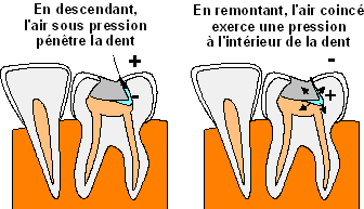 Schéma expliquant le phénomène du barotraumatisme dentaire en plongée sous-marine
